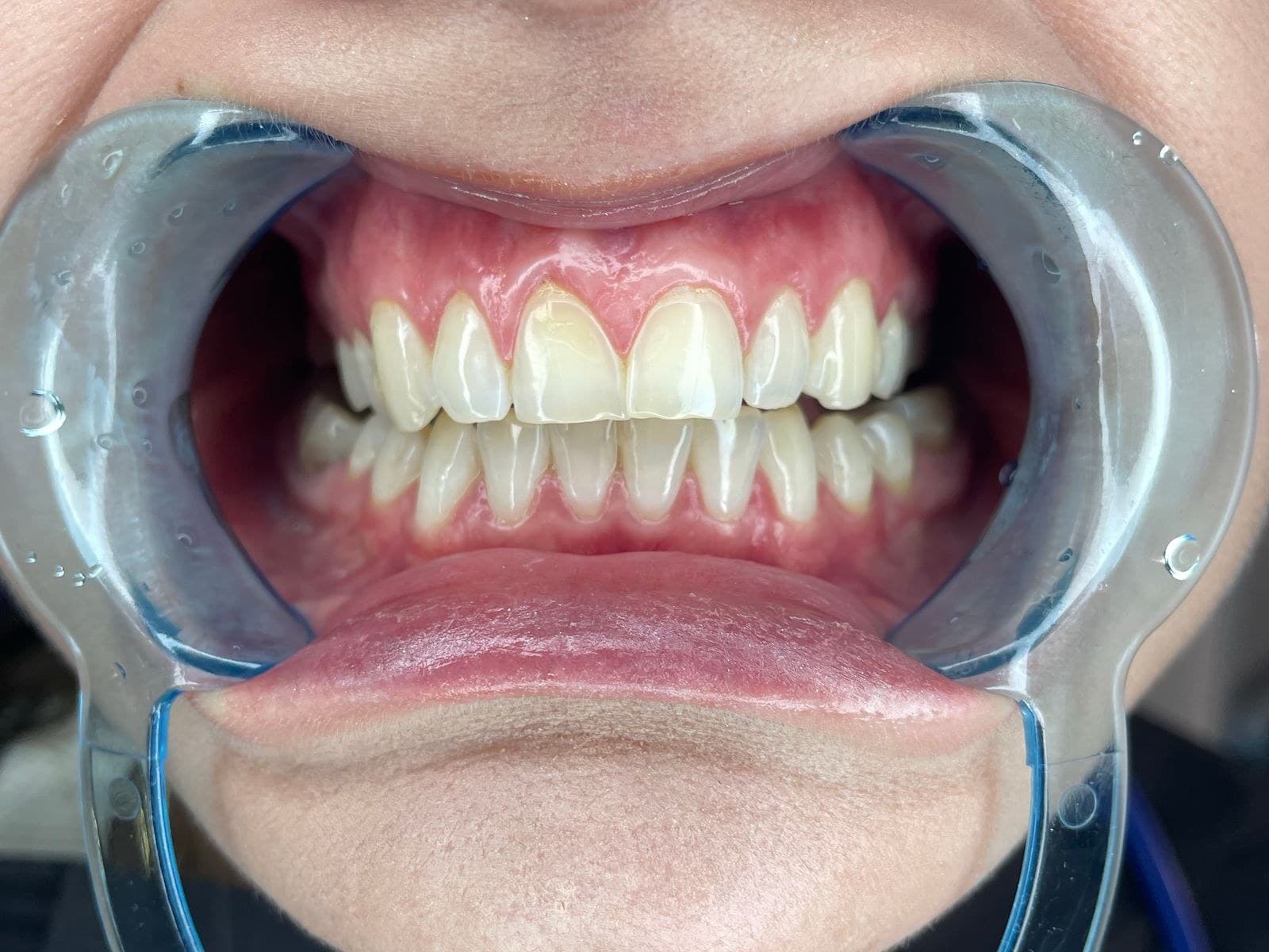 Close-up of the front teeth during a dental examination