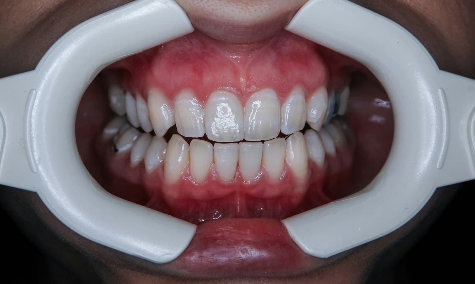 Dental assessment of gums and teeth for signs of gum disease stages