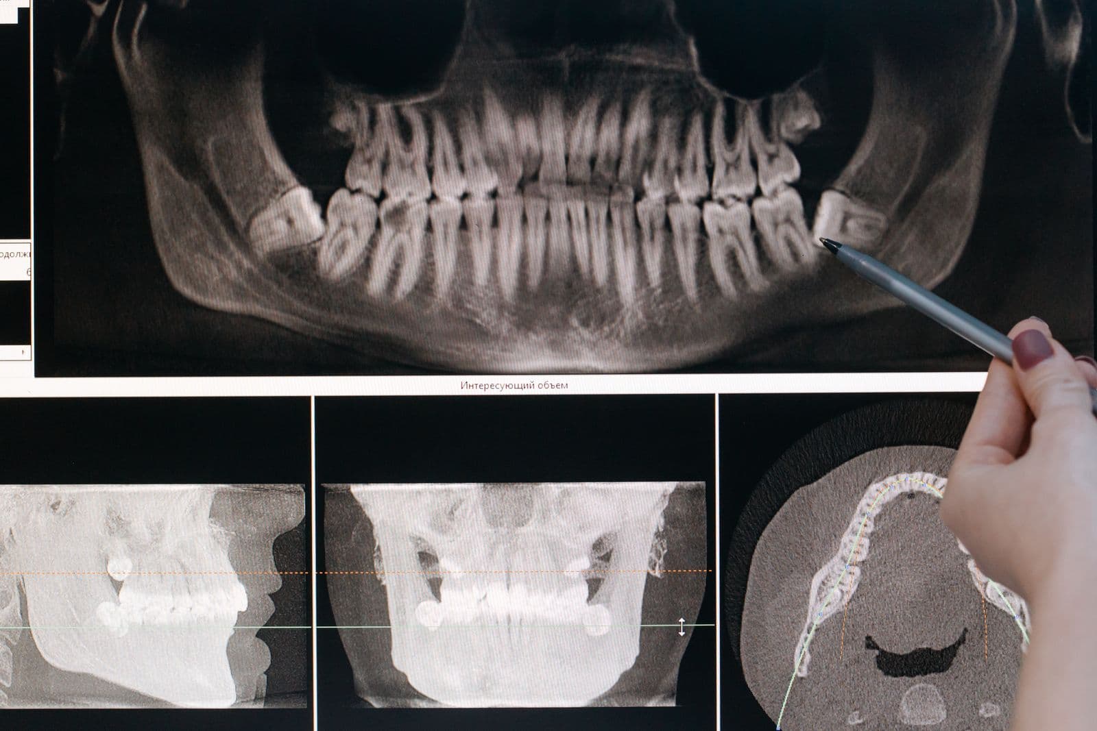 Wisdom Teeth Removal: Signs, Cost in Sydney & Recovery Guide