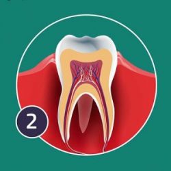 chronic-periodontis-300x300