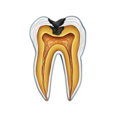tooth-cavity
