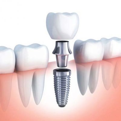 dental-implants3
